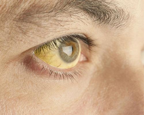 Mắt của người bị bệnh gan có thay đổi không? Dấu hiệu nhận biết sớm