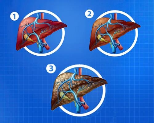 Phân loại gan nhiễm mỡ: Hiểu rõ các cấp độ và mức độ nguy hiểm