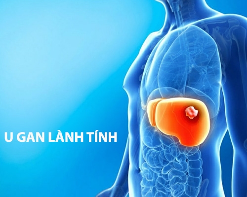 U gan lành tính có chữa được không? Giải đáp nhanh