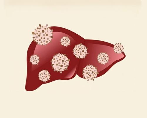 Viêm gan virus mạn là gì? Nguyên nhân và dấu hiệu nhận biết sớm