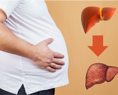 Tìm hiểu bệnh xơ gan cổ trướng có lây không?