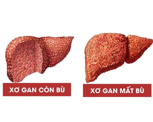 Xơ gan còn bù và xơ gan mất bù khác nhau thế nào?