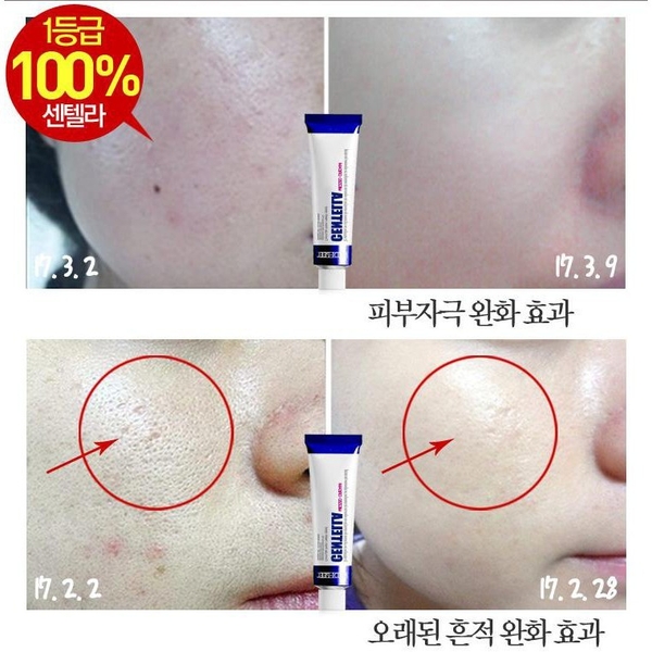 Miếng dán mụn cosrx-hàn