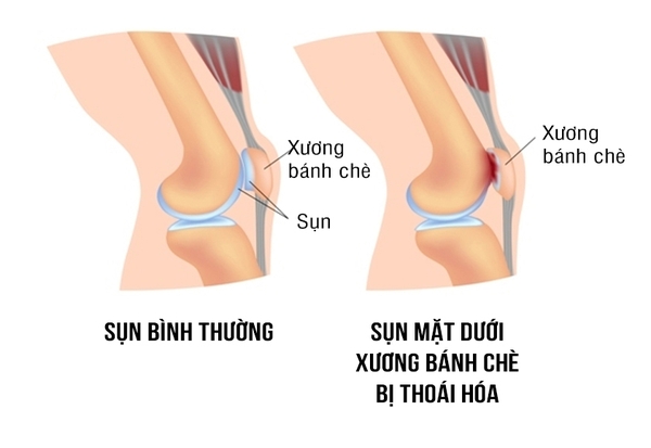 Nhuyễn sụn xương bánh chè
