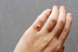 Tìm Hiểu Bệnh Mụn Cóc Là Gì? Nguyên Nhân Gây Ra Và Phương Pháp Điều Trị An Toàn