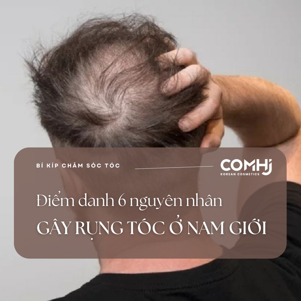 ĐIỂM DANH 6 NGUYÊN NHÂN GÂY RỤNG TÓC Ở NAM GIỚI