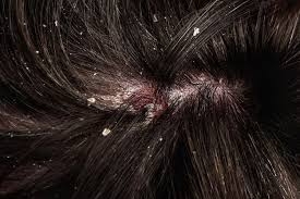 Giải Quyết Vấn Đề Gàu Ngứa Cho Phái Đẹp - Chăm Sóc Tóc Cùng COMHJ