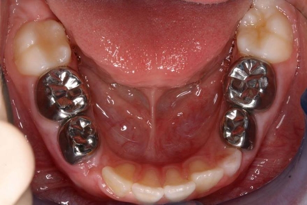Chụp thép trẻ em là gì