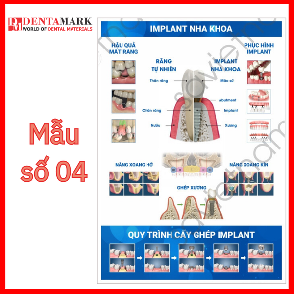 Tranh nha khoa - Tranh tư vấn dịch vụ nha khoa 4