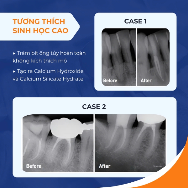 Chất hàn ống tủy Bioceramic Dia Root Bio Sealer DiaDent Hàn Quốc