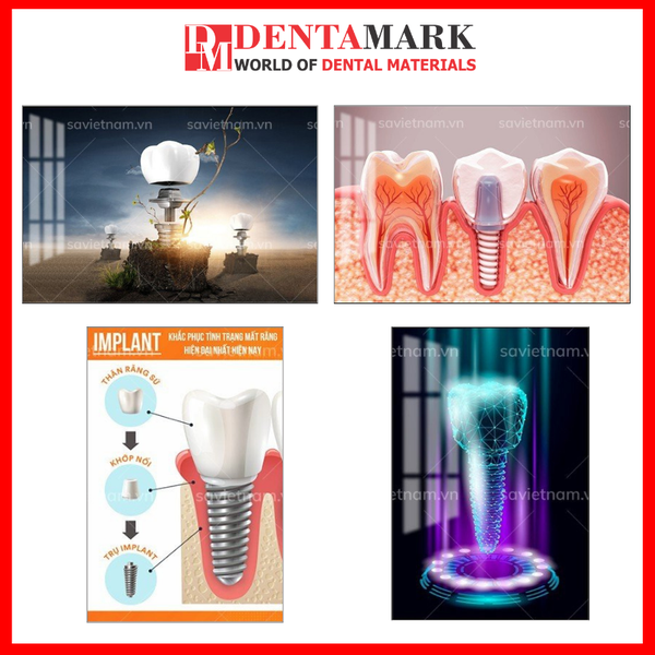Tranh nha khoa đẹp Implant trang trí phòng khám