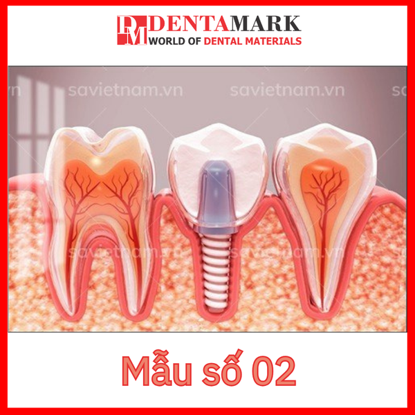Tranh nha khoa Implant trang trí phòng khám 3.1
