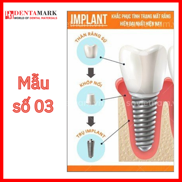 Tranh nha khoa Implant trang trí phòng khám 4.1