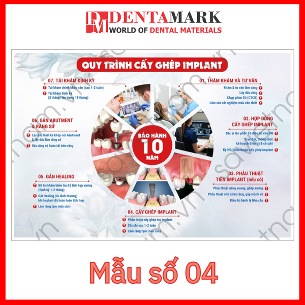 Tranh nha khoa - Tranh quy trình nha khoa - Quy trình cấy ghép implant - ngang