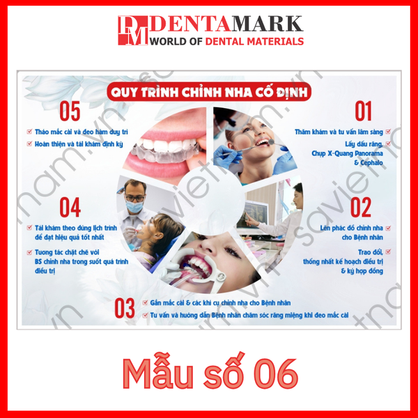 Tranh nha khoa - Tranh quy trình nha khoa - Quy trình chỉnh nha cố định - ngang