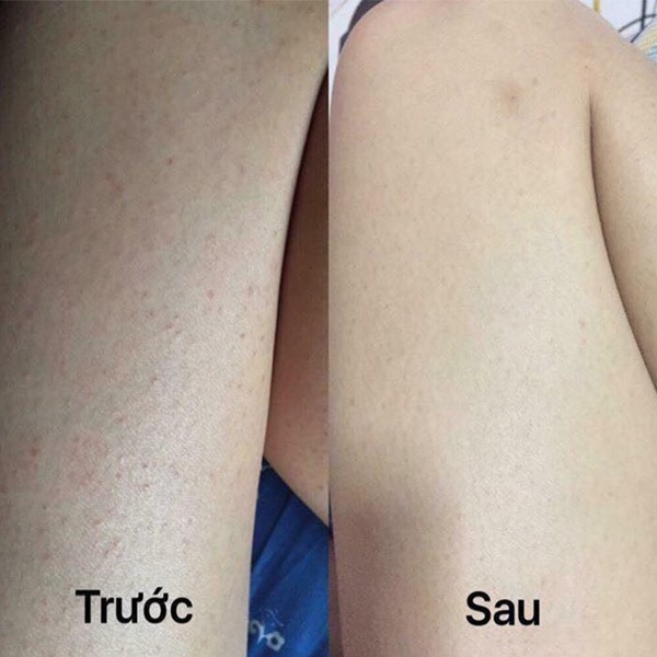 Điều trị viêm nang lông vĩnh viễn