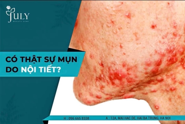Có thật sự mụn do nội tiết mà ra?