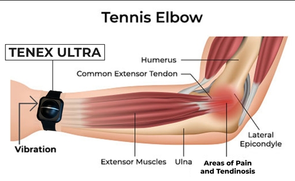 Đồng hồ giảm chấn Tenex Elbow Shock Absorber