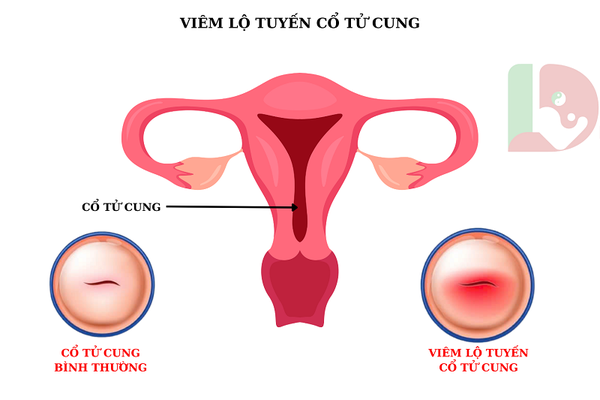 VIÊM LỘ TUYẾN CỔ TỬ CUNG CÓ NGUY HIỂM KHÔNG. NGUYÊN NHÂN, ĐIỀU TRỊ VIÊM LỘ TUYẾN?