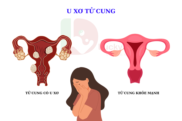 U XƠ TỬ CUNG LÀ GÌ, CÓ NGUY HIỂM KHÔNG?