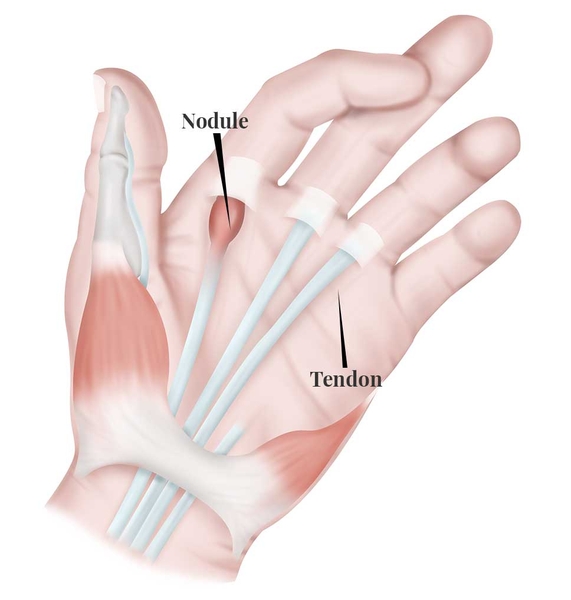 Ngón tay cò súng (Trigger finger)