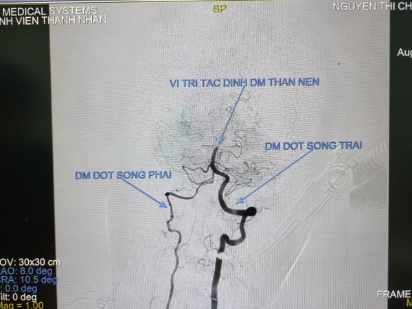 Chụp và can thiệp mạch lấy huyết khối động mạch não số hóa xóa nền bằng dụng cụ cơ học