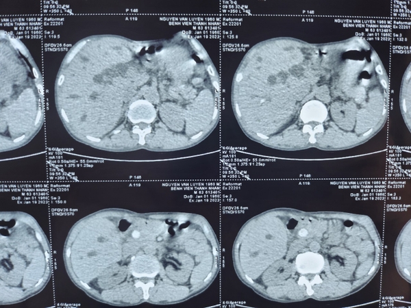 TÁN SỎI ĐƯỜNG MẬT QUA DA –  KỸ THUẬT MỚI XÂM LẤN TỐI THIỂU, HIỆU QUẢ TỐI ĐA