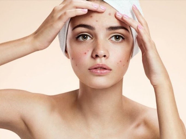 Trị mụn tại nhà bằng những thực phẩm quen thuộc