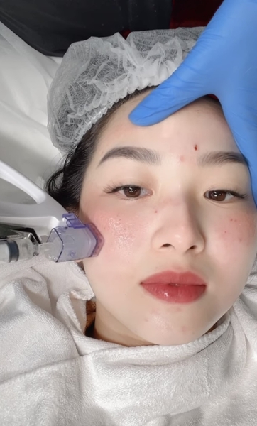 Mesotherapy: Phương Pháp Làm Đẹp Hiện Đại và Hiệu Quả?