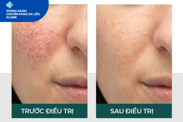 trị nám