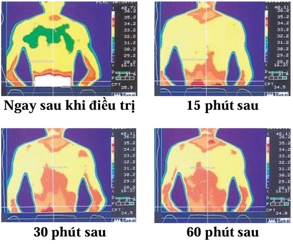 Tác dụng của máy điều trị từ-nhiệt-rung