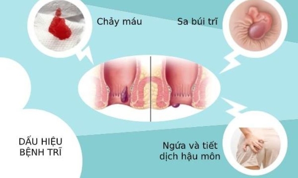 Bệnh trĩ có nguy hiểm không?