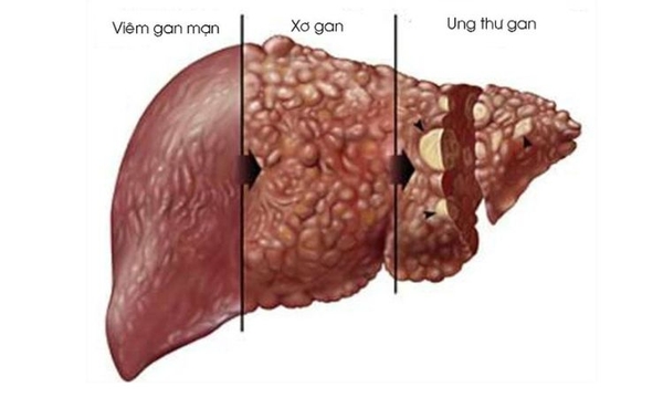 Cảnh báo các căn bệnh liên quan đến gan