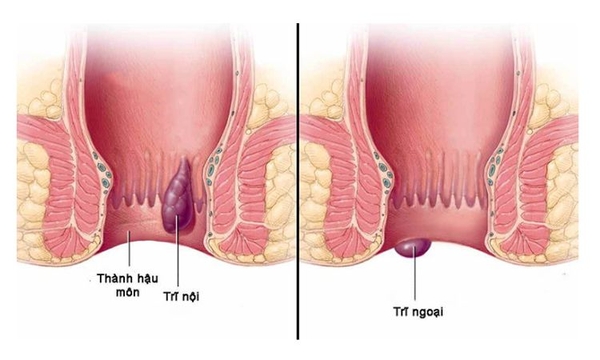 Các biến chứng nguy hiểm khi bị bệnh trĩ
