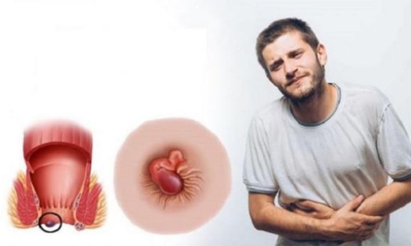 Vì sao người mắc trĩ nên luyện tập