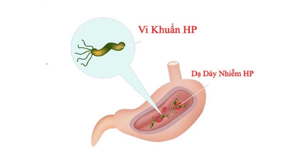 Đau dạ dày do vi khuẩn HP