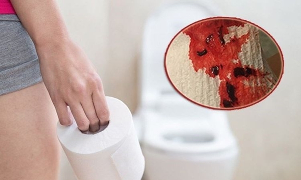 Dấu hiệu bệnh trĩ