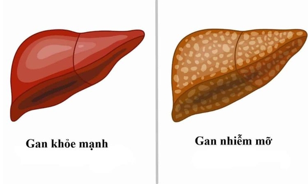Gan nhiễm mỡ là gì?