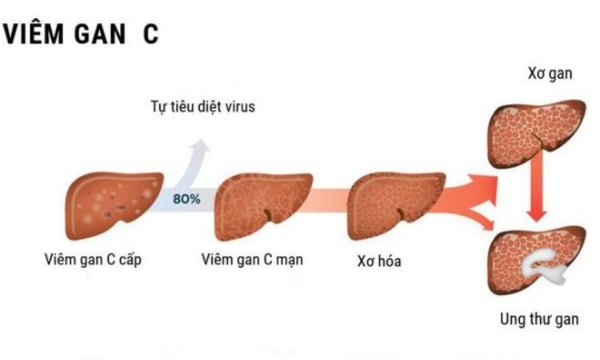Giai đoạn tiến triển của viêm gan C
