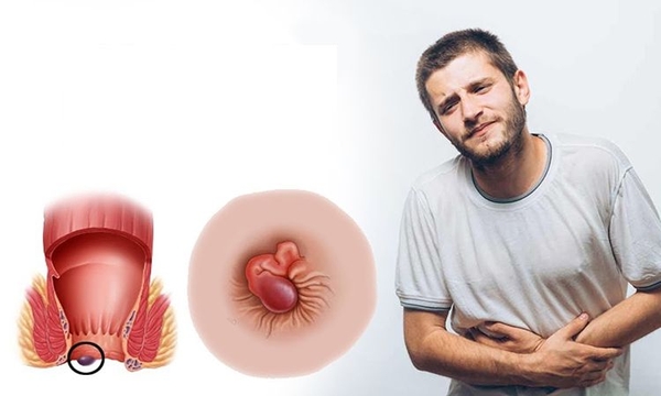 Nguyên nhân gây bệnh trĩ