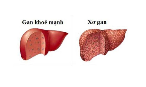 Cách phòng xơ gan hiệu quả