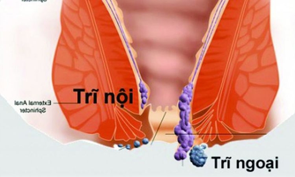 Phân biệt trĩ nội trĩ ngoại