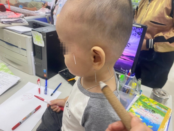 TP.HCM: Bé 1 tuổi liệt mặt, méo miệng do ngủ quạt sai cách