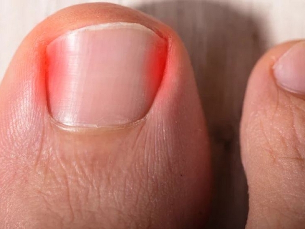 Chuyện lạ: Chàng trai 18 tuổi ở Úc tử vong vì móng chân mọc ngược