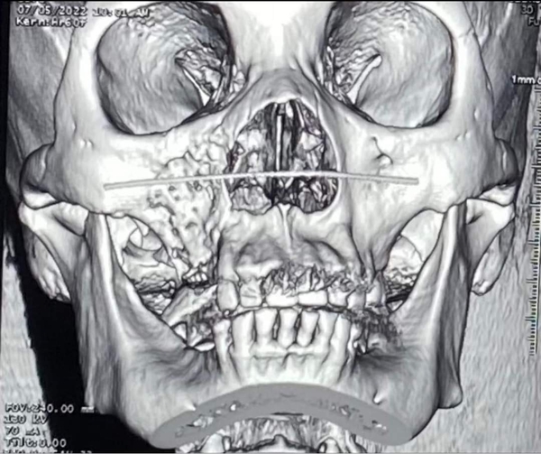 Hàng loạt ca bệnh hoại tử xương hàm trên: Sở Y tế TP.HCM vào cuộc
