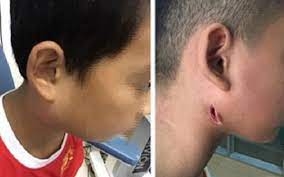 Bé gái ở Đăk Lăk nhiễm 'vi khuẩn ăn thịt người'