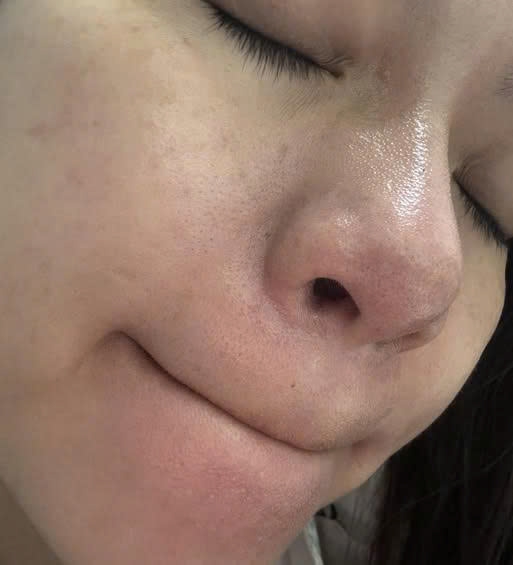 Da sạm, lỗ chân lông to với mụn li ti thì dùng gì cho nhanh đẹp ạ?