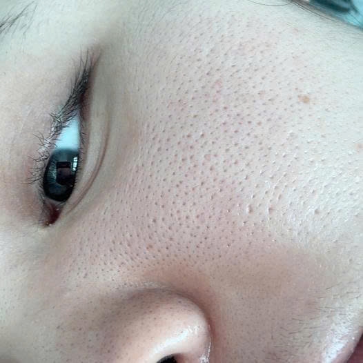 Lỗ chân lông to như hố bom thế này thì skincare kiểu gì ạ? 😭