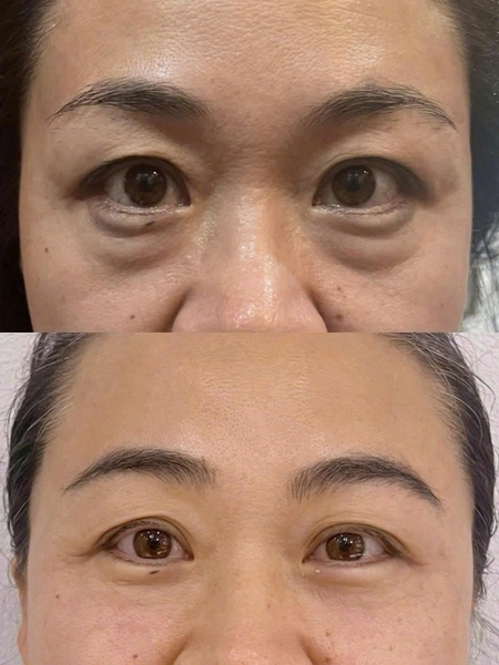 U60 vẫn trẻ ra chục tuổi nhờ xử lý đúng chỗ thâm bọng mắt!