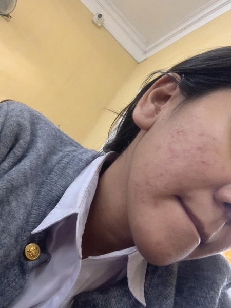 Da lên mụn li ti khắp mặt thế này, chị em chỉ em cách skincare với! 😭